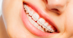 Ceramic braces at Growing smiles Orthodontic clinic in Bangalore