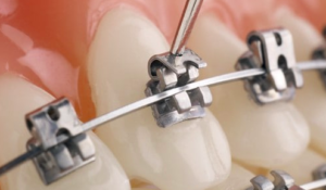 Metal self ligating braces in Bengaluru