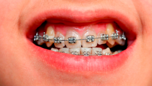 Traditional metal braces in Bangalore