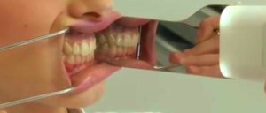 Step 2 Intraoral Photography
