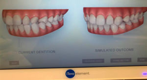 Step 4 - Extra oral Orthodontic facial assessment