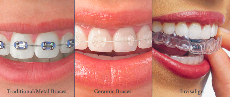 Step 7 - Orthodontic braces selection​