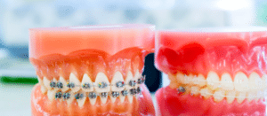 What is an Orthodontist? Growing Smiles Orthodontics Bengaluru