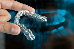 Do I need a mouthguard?