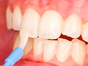 Fluoride varnish prevents dental caries in kids