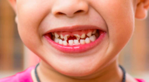 What is Early Childhood Caries