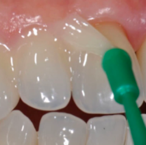 Fluoride application for kids at Growing Smiles Pediatric Dentistry