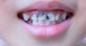 How Does Fluoride Help In Preventing Dental Caries