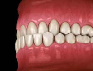 Crossbite and underbite can lead to mouth breathing