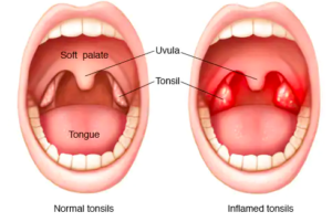 Enlarged tonsils can also cause mouth breathing