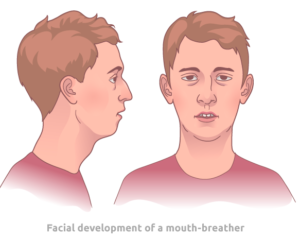 Mouth breathing can change in facial appearance