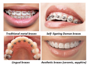 The-different-types-of-orthodontic-braces-an-orthodontist-provides