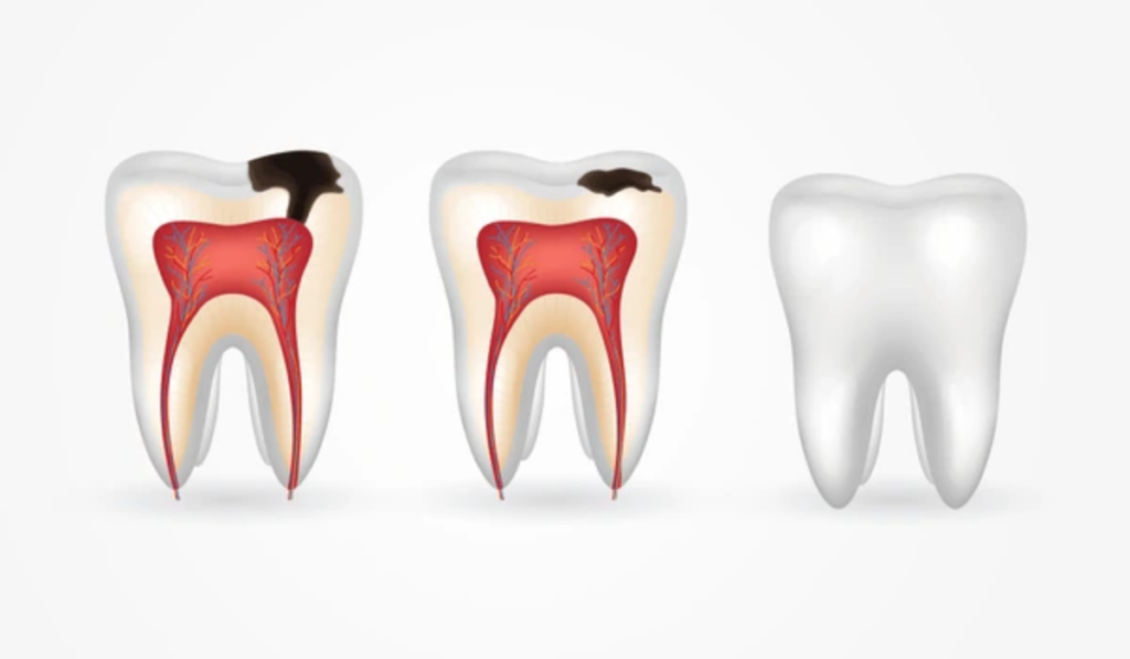 Tooth Decay