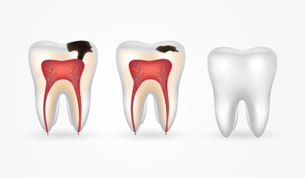 Tooth Decay