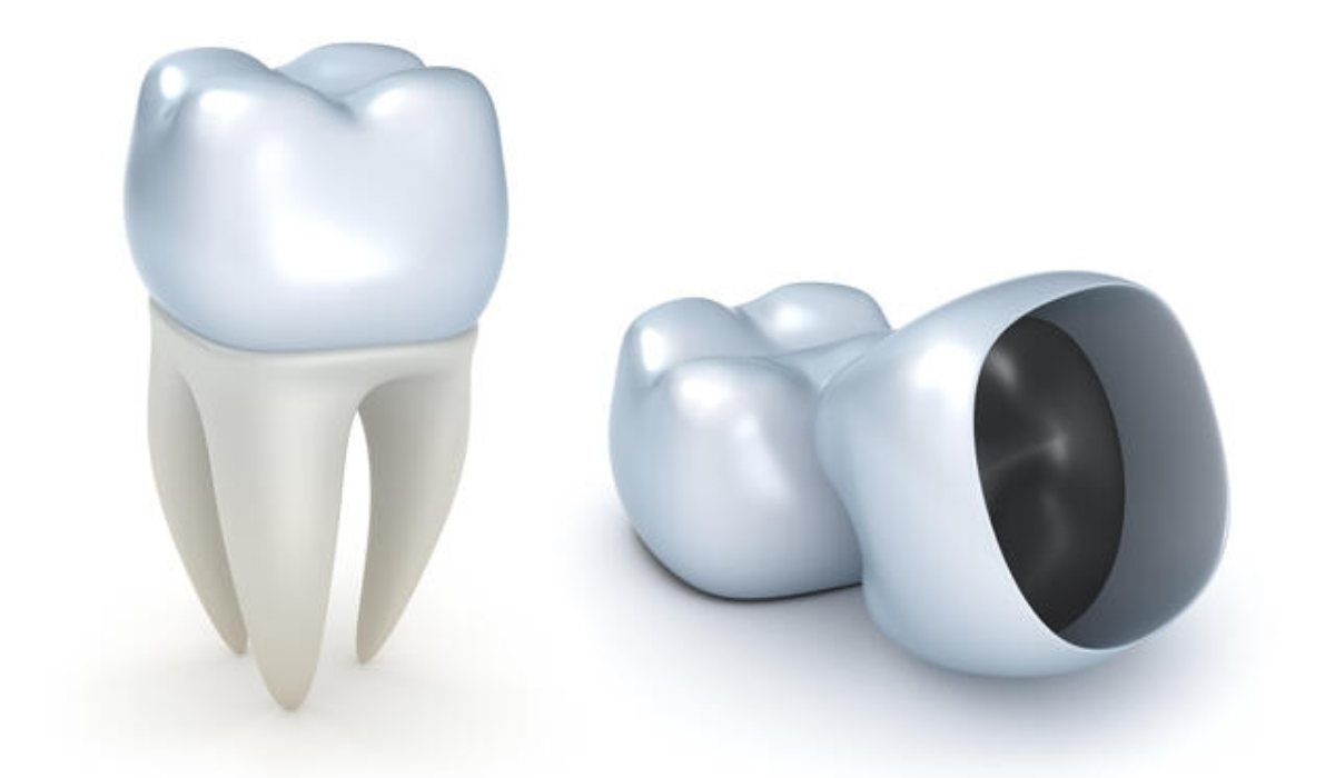 Dental Crown Treatment