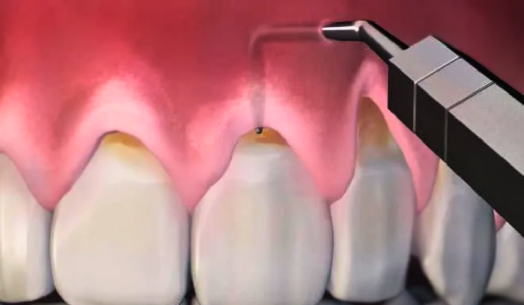 Pinhole Gum Surgery