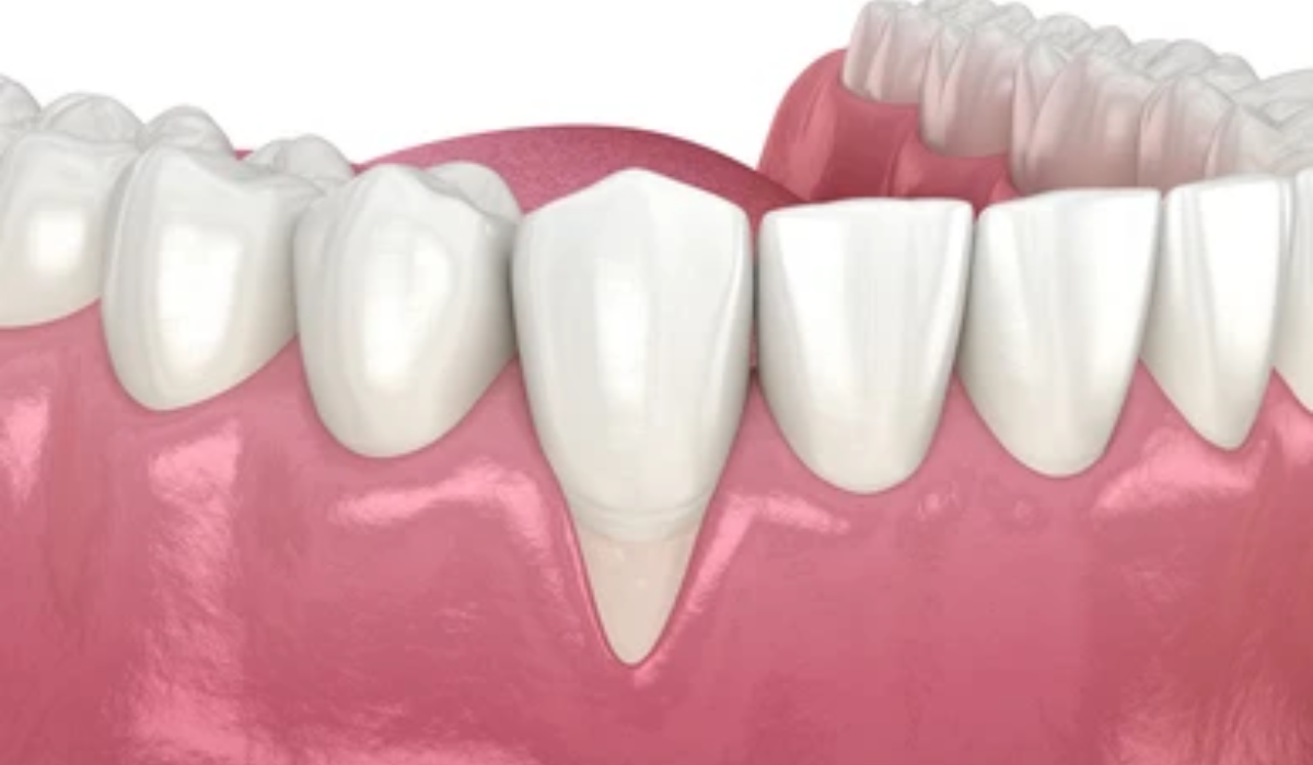 Gum Disease treatment in whitefield