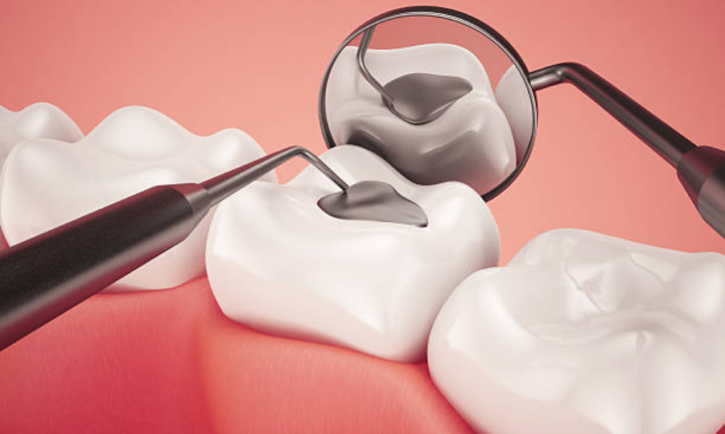Dental Fillings