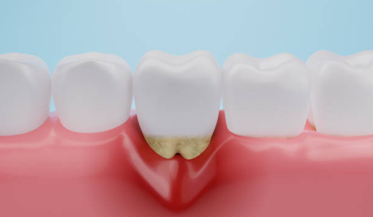 Gum disease treatment in whitefield