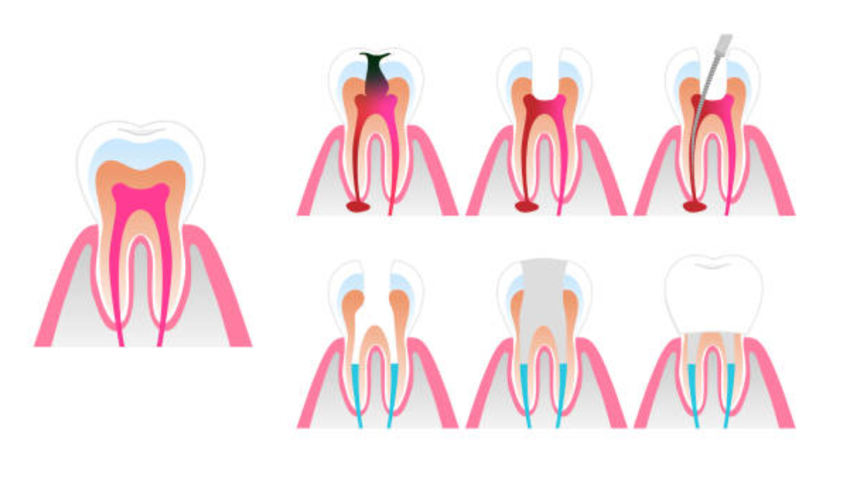 Root canal treatment