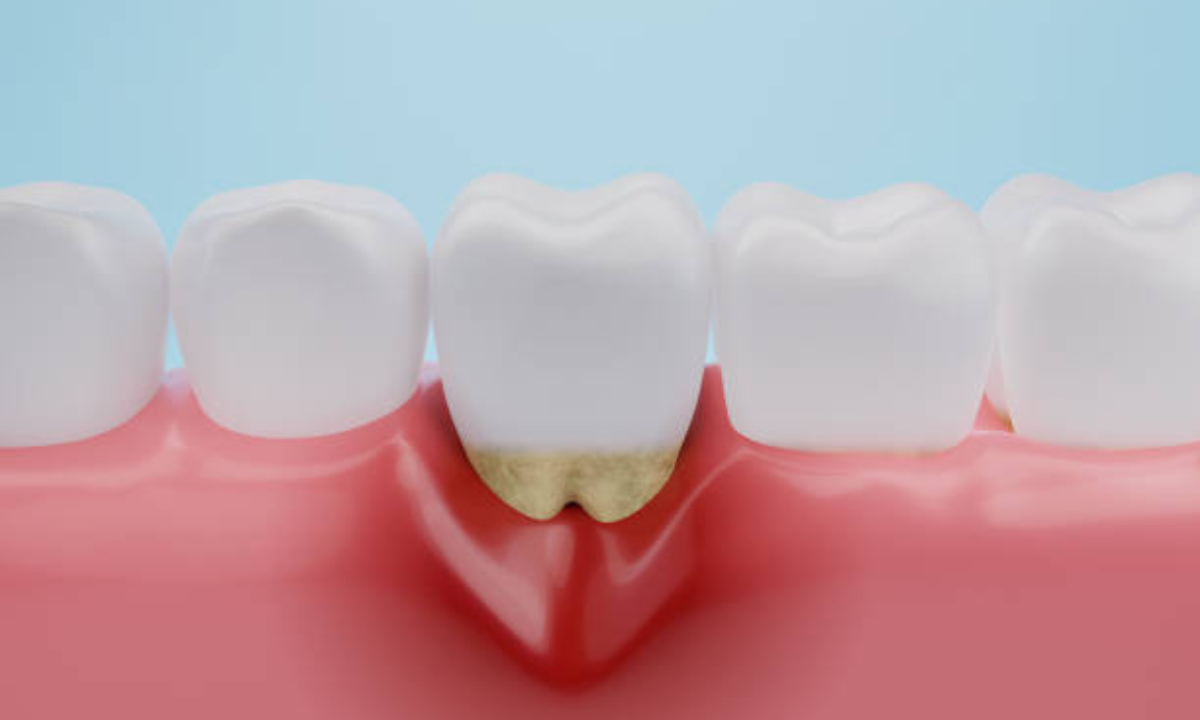 gum disease treatment in whitefield
