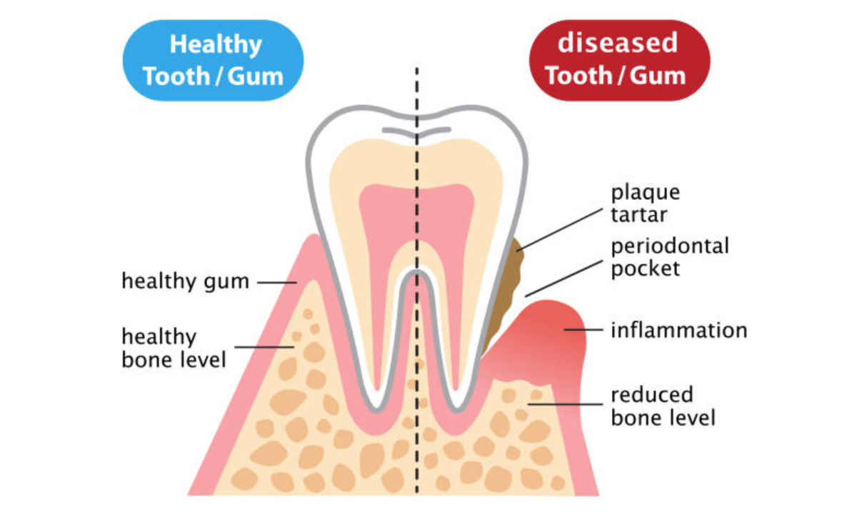 gum disease treatment in whitefield