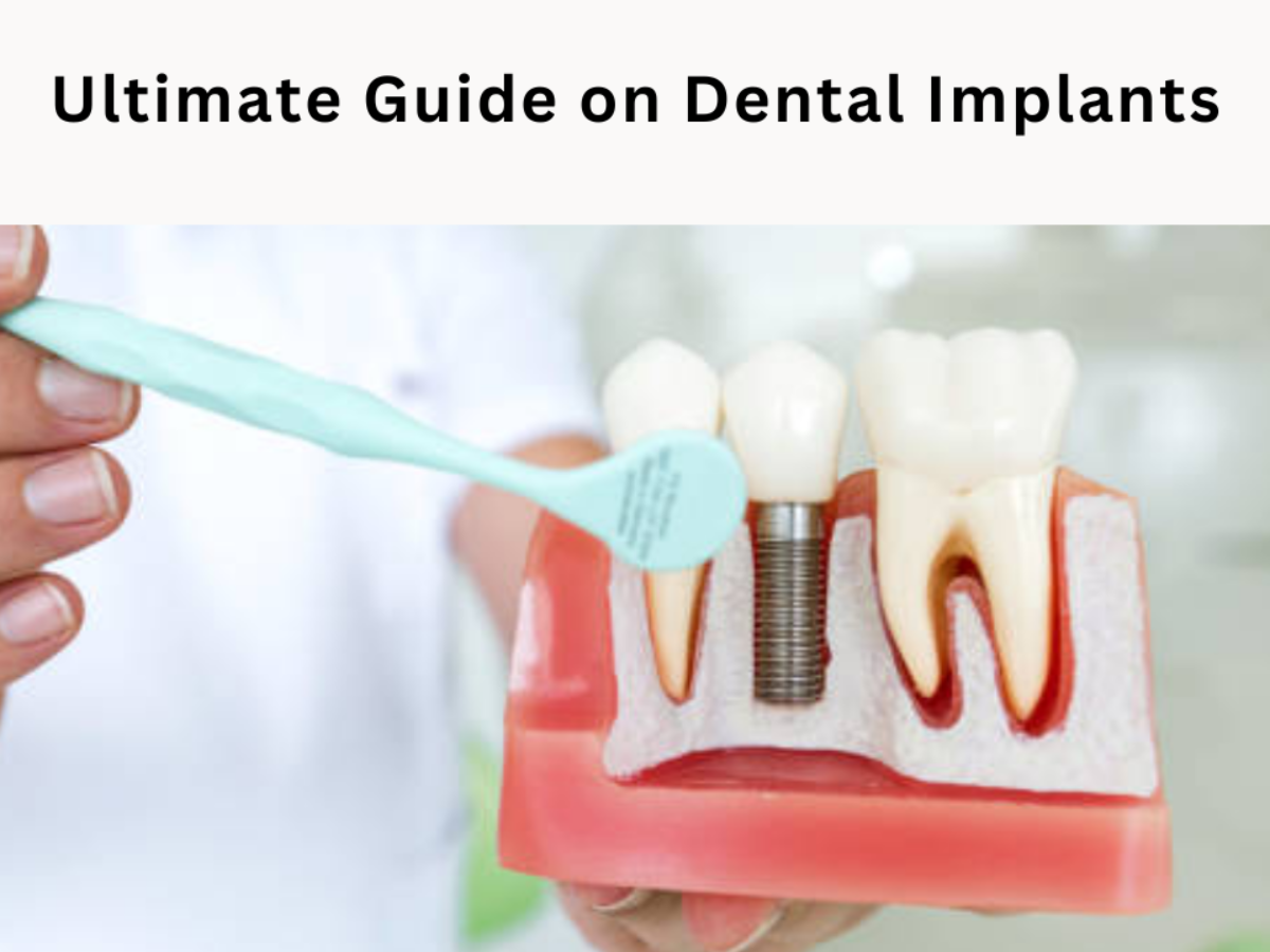 Ultimate Guide on Dental Implants: Procedure and Benefits