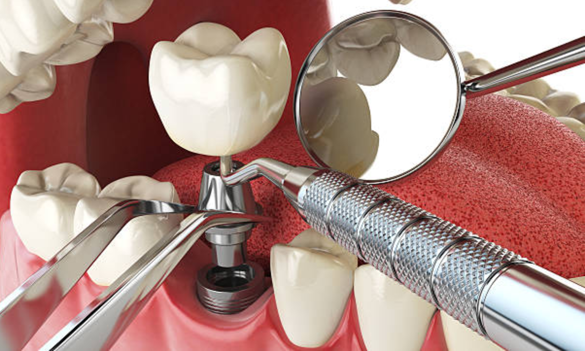 Dental implant surgery: Benefits in Long-term Dental Health