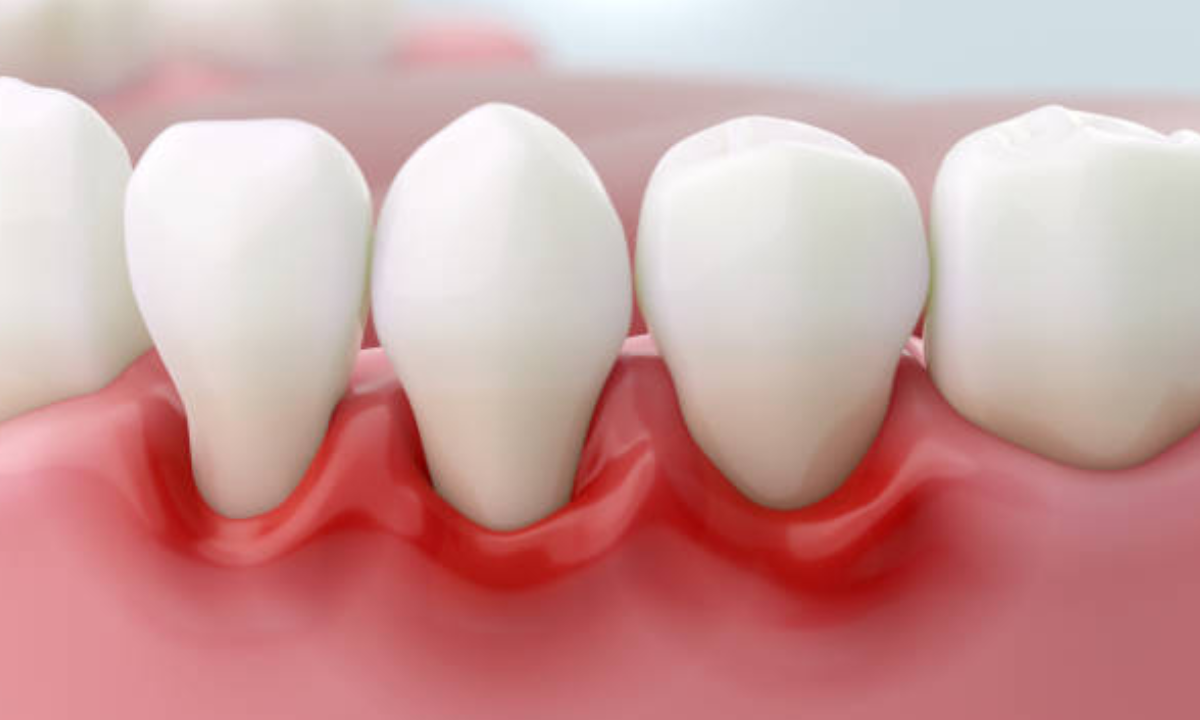 gum disease treatment in whitefield