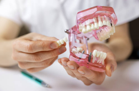 dental implants