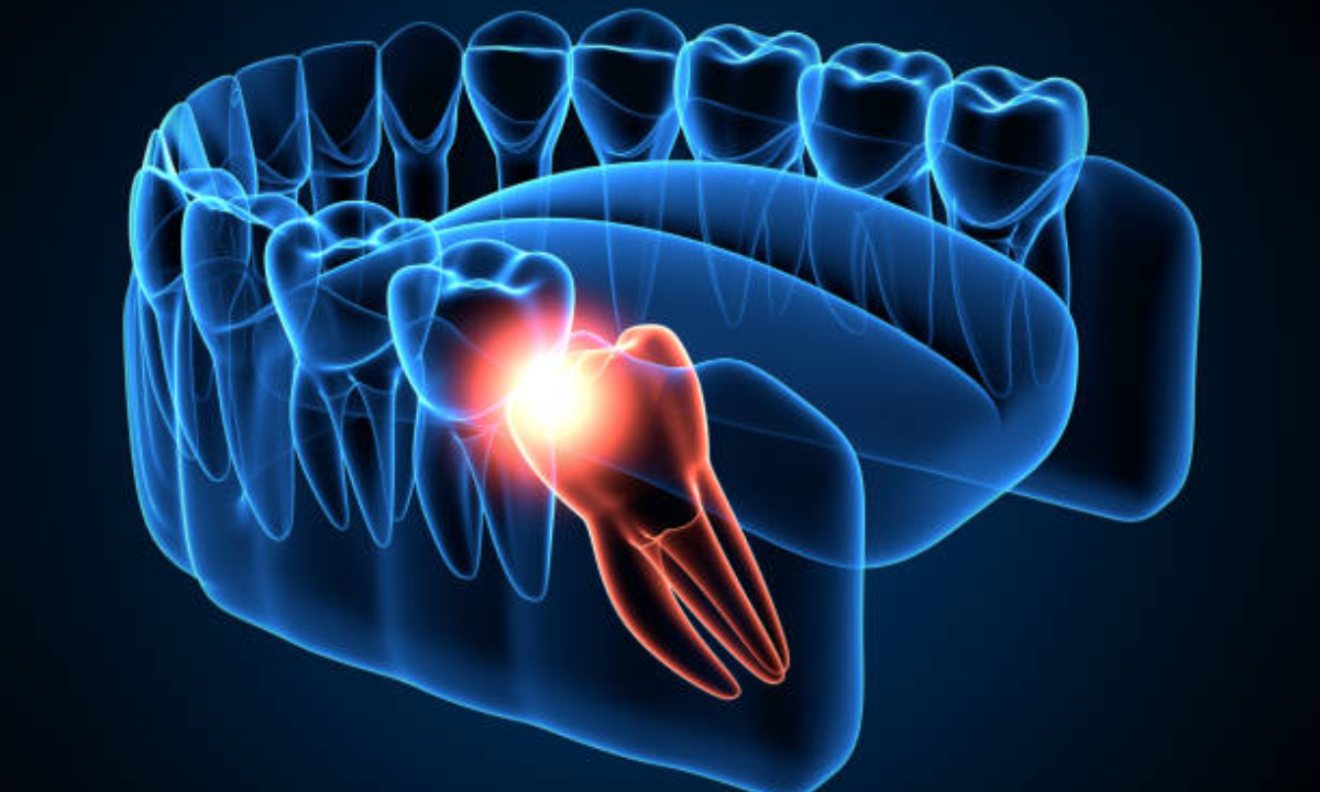 wisdom teeth removal