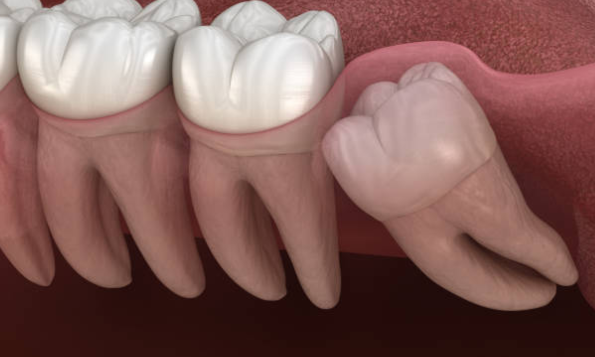wisdom teeth removal in whitefield