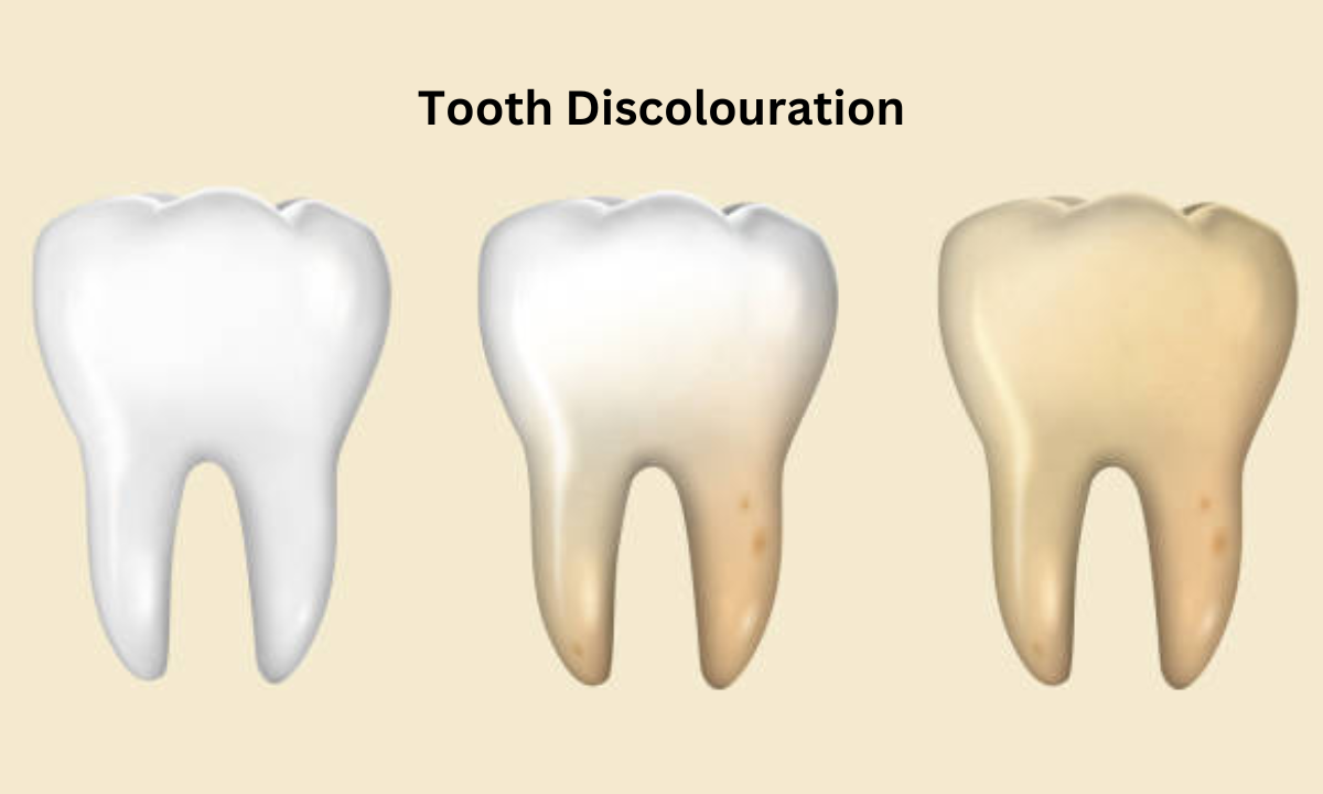 tooth discolouration