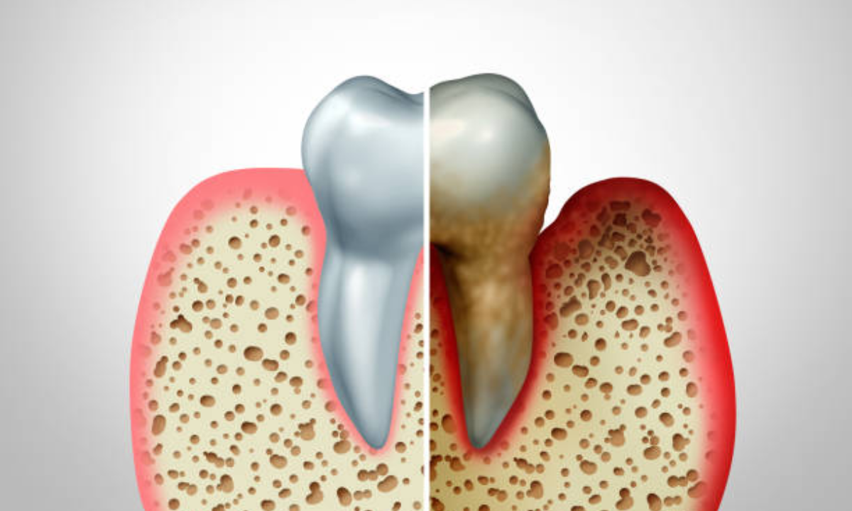 Gum disease treatment in whitefield