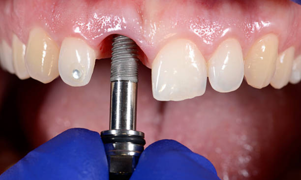 dental implants in whitefield
