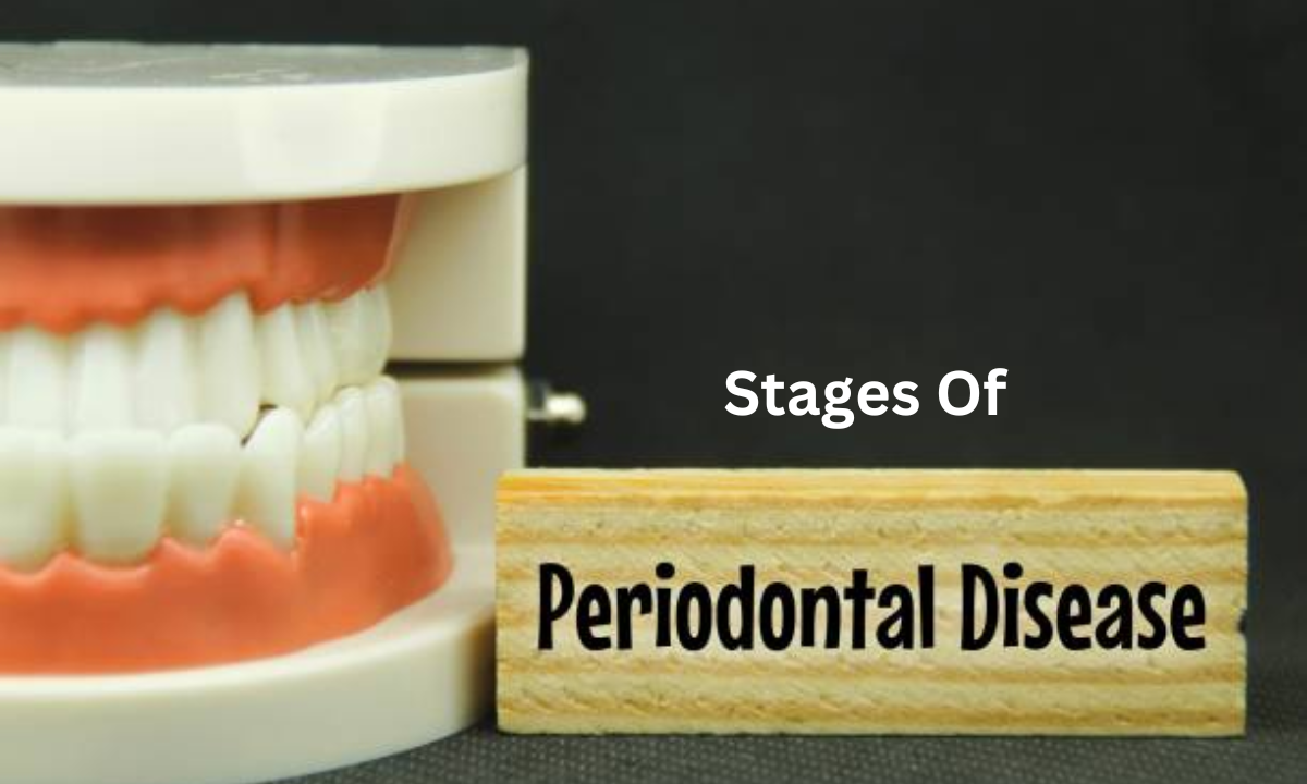 Stages of Periodontal Disease