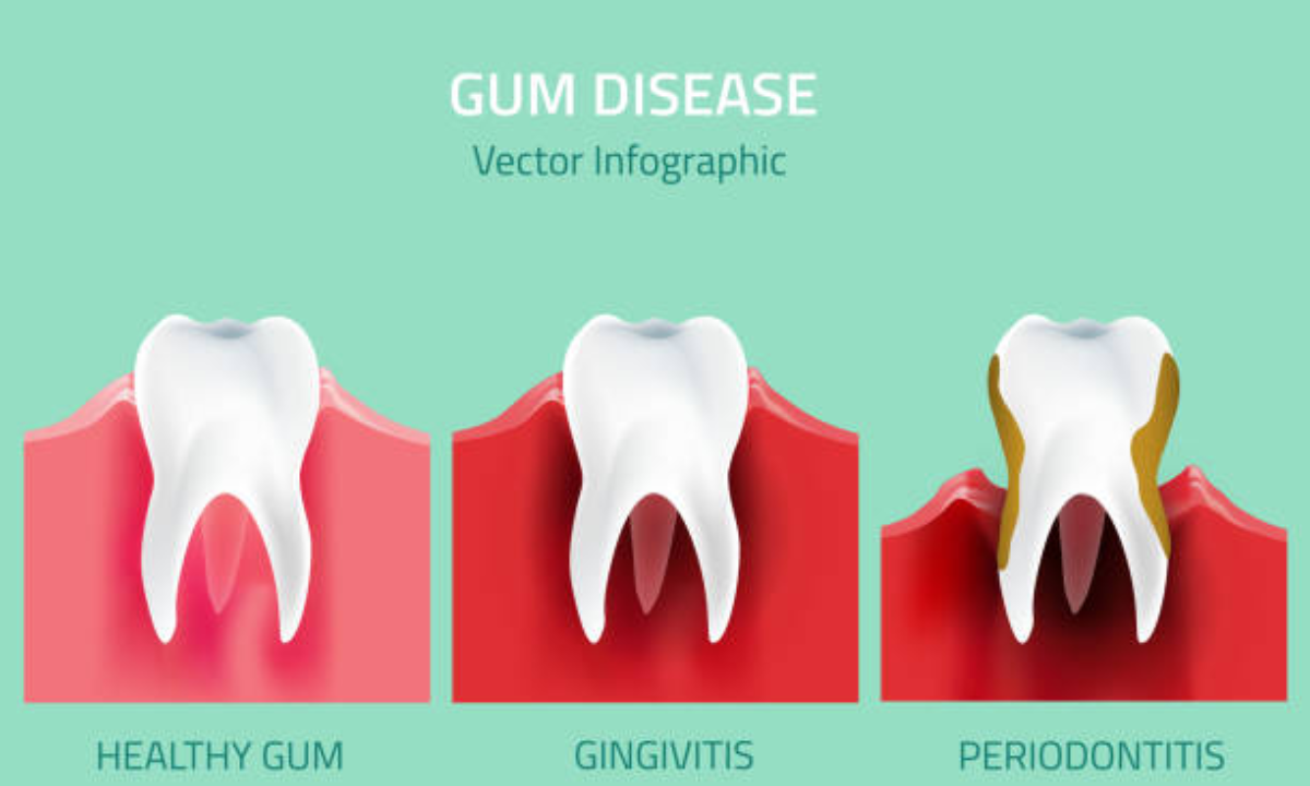 gum disease treatment in whitefield