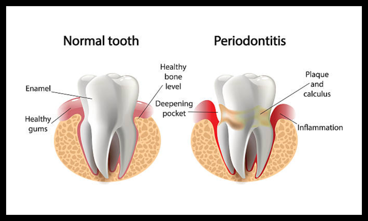 gum disease treatment in whitefield