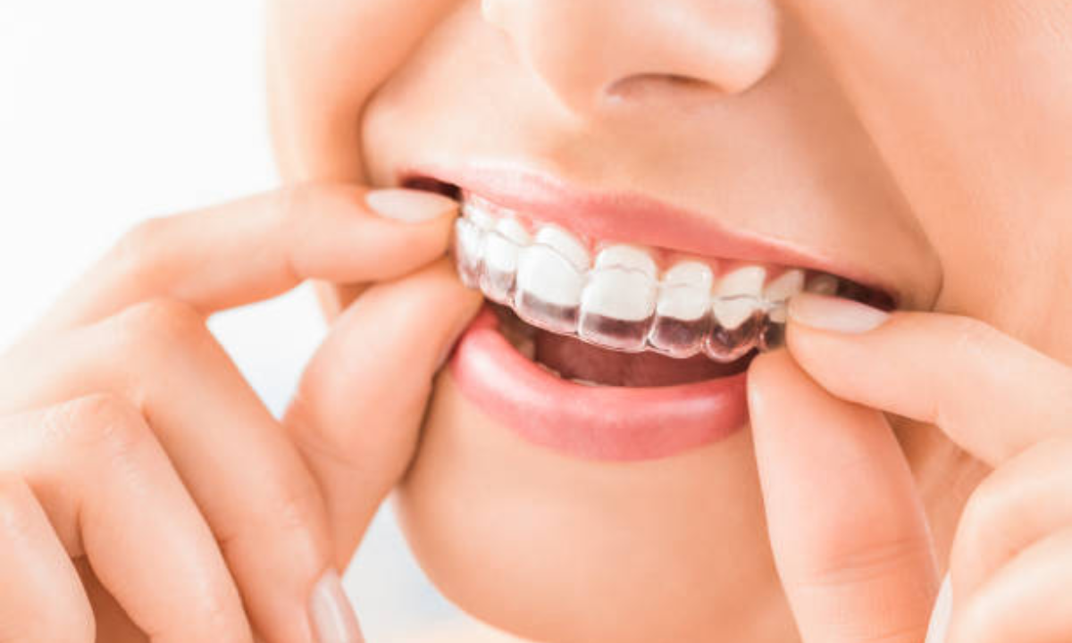 invisalign braces in whitefield