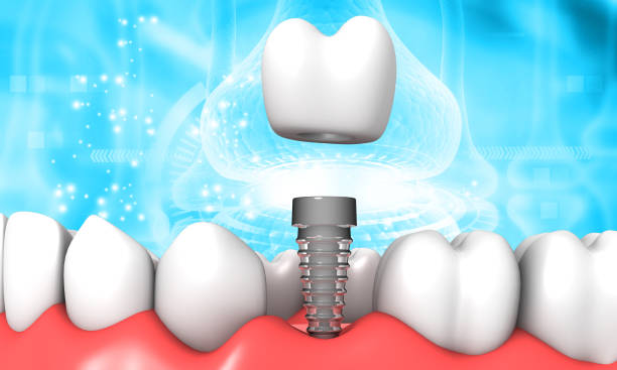 dental implants in whitefield