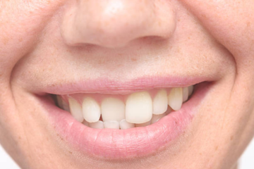 invisalign aligners