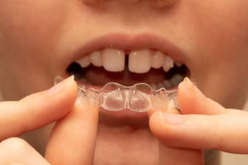 invisalign aligners in bangalore
