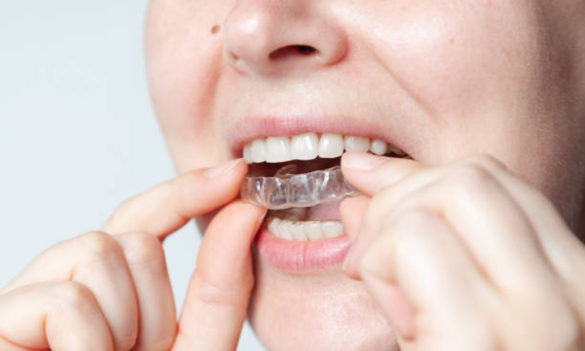 Invisalign aligners in Bangalore