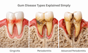 Understanding the Types of Gum Disease