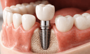 Understanding Dental Implants